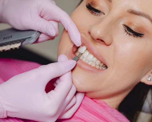 Verblendschalen bei Zahnschäden: Veneers